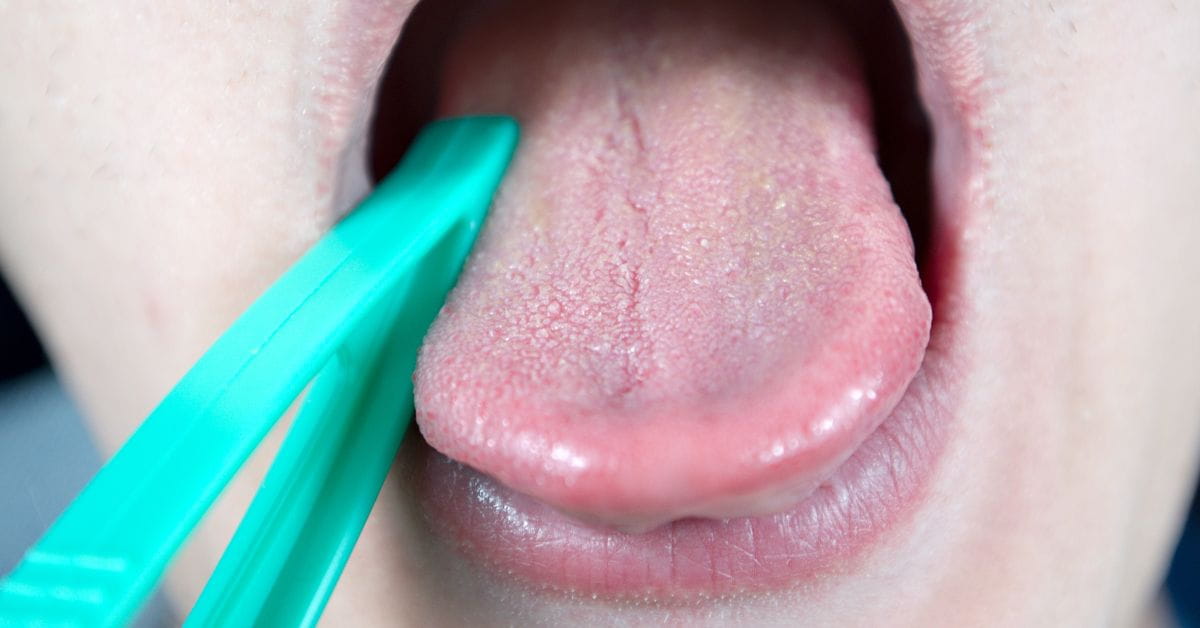 tongue examination